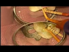 SANI TREATMENT Trường hợp